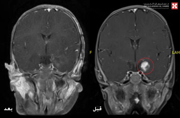 مستشفى-الدكتور-سليمان-الحبيب-بالخبر-يُنهي-معاناة-رضيعة-مع-ورم-بالدماغ-تسبب-بتشنجات-صرعية-حادة