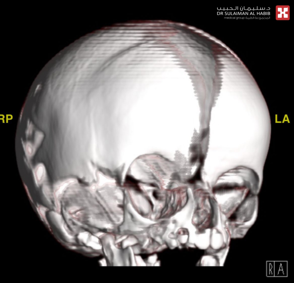 مستشفى-الدكتور-سليمان-الحبيب-بالخبر-يعيد-بناء-عظام-الجمجمة-بالمنظار-لرضيعه-تعاني-من-تشوه-خلقي